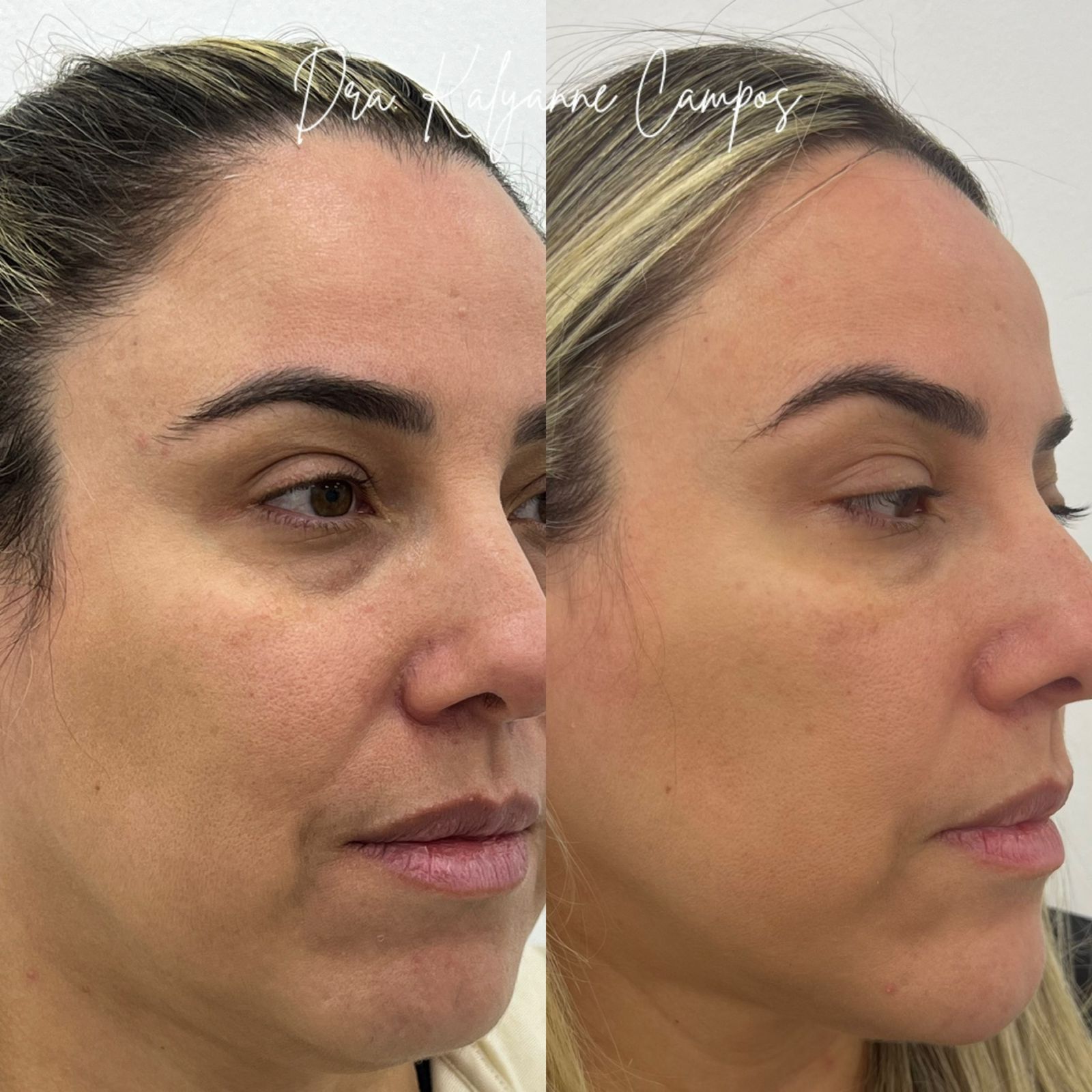 Aplicação de Bioestimuladores de Colágeno em São Paulo