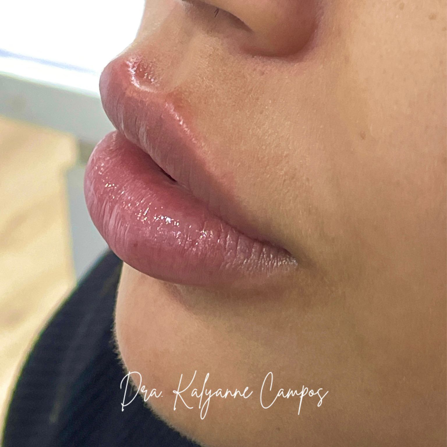 Resultado de Harmonização Facial Natural