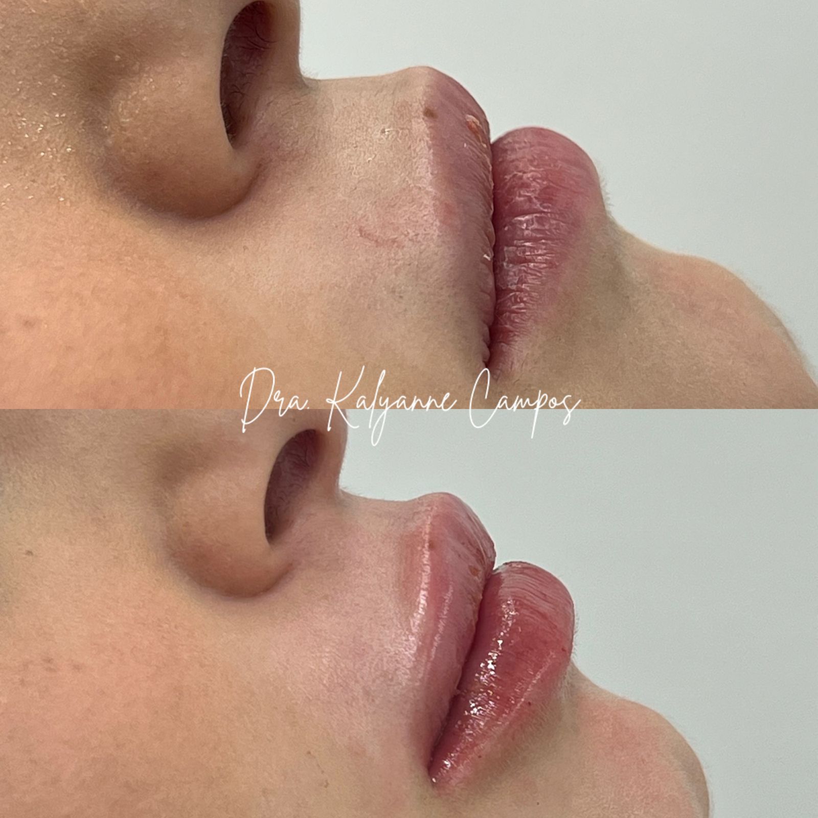 Definição de Contorno Labial e Hidratação